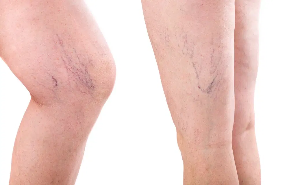 Vein Lesions Removal