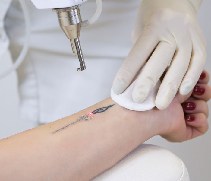 Tattoo Reduction